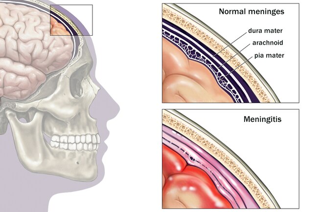 https://img.webmd.com/dtmcms/live/webmd/consumer_assets/site_images/articles/health_tools/visual_guide_meningitis_slideshow/1800ss_medicalimages_rm_brain_meninges_illustration.jpg?*=