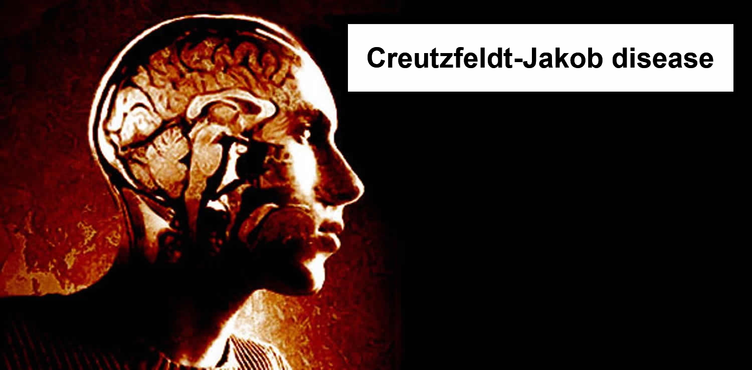 https://medqaz.com/wp-content/uploads/2020/12/Creutzfeldt-Jakob-disease.jpg