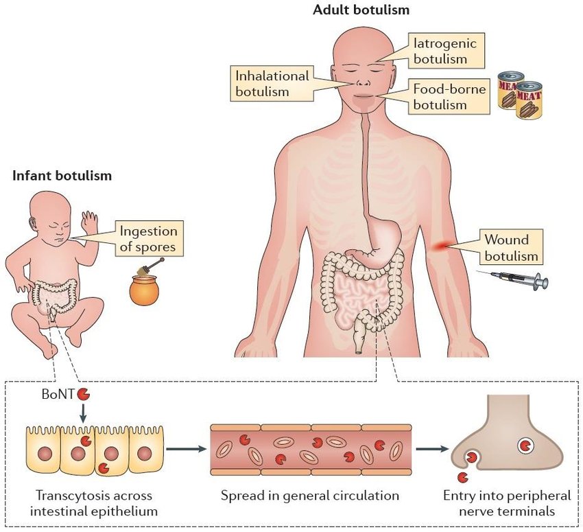 https://www.researchgate.net/profile/Cedric_Woudstra/publication/304792202/figure/fig2/AS:380429820547074@1467712945210/Human-form-of-botulism-Intoxination-due-to-consumption-of-food-content with.png