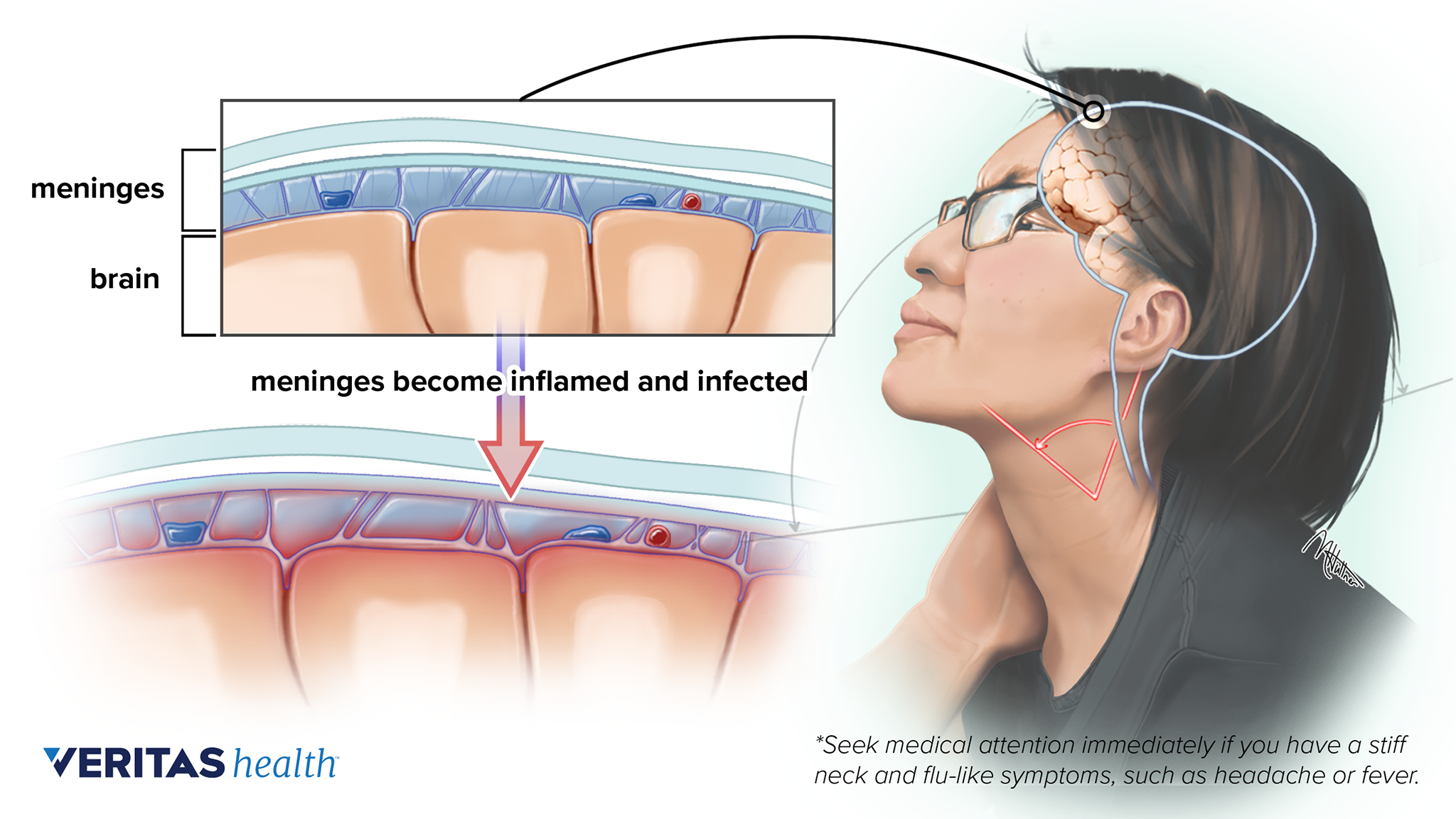 https://embed.widencdn.net/img/veritas/amxvn181c7/exact/Meningitis.png?keep=c&crop=yes&u=o5culx&use=mf1k7