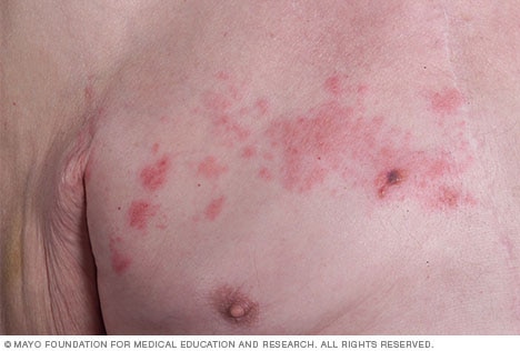 Shingles (герпес зостер): себептері, белгілері және емі Shingles (герпес зостер): себептері, белгілері және емі
