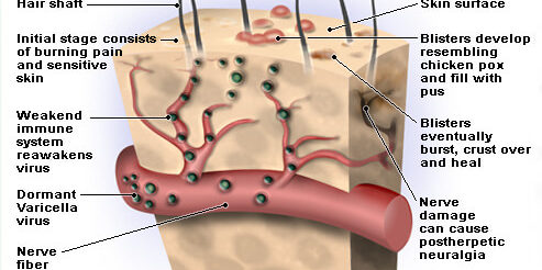 https://medqaz.com/wp-content/uploads/2020/12/shingles-s2-illustration-of-shingles-virus-493x246.jpg